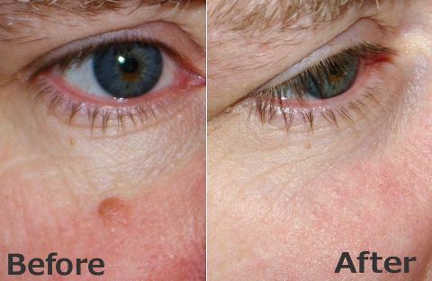 Removing A Mole with Essential&nbsp;Oils